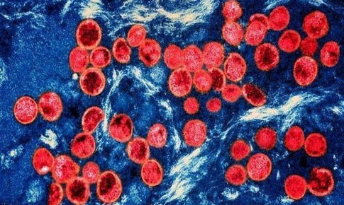 Ph&#225;p ph&#225;t hiện ca nhiễm biến thể mới của virus đậu m&#249;a khỉ