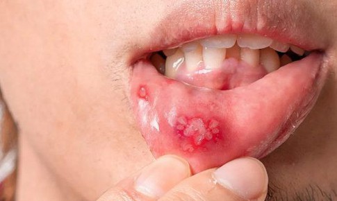 Vết thương hở và nguy cơ lây truyền HIV: Hiểu rõ để phòng ngừa hiệu quả