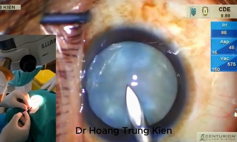 Đột phá mới trong phẫu thuật đục thủy tinh thể chín trắng căng phồng