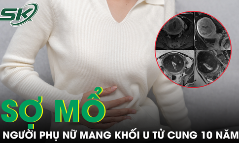 Người phụ nữ mang khối u xơ tử cung gần 5kg suốt 10 năm vì tin rằng 'u sẽ tự hết'