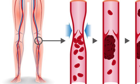 7 dấu hiệu cảnh báo sớm cục máu đông, phòng ngừa như thế nào?