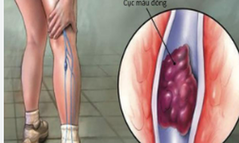 Ngồi lâu: Nguy cơ cục máu đông nguy hiểm, cách nào phòng ngừa hiệu quả?