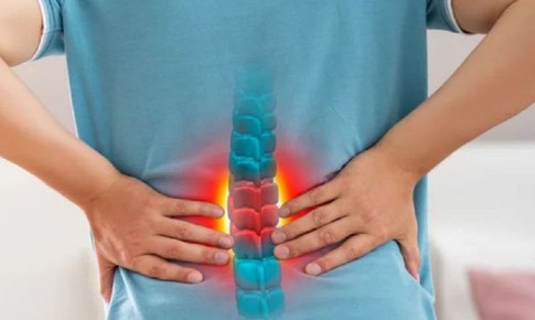 Gai cột sống có nguy hiểm không?