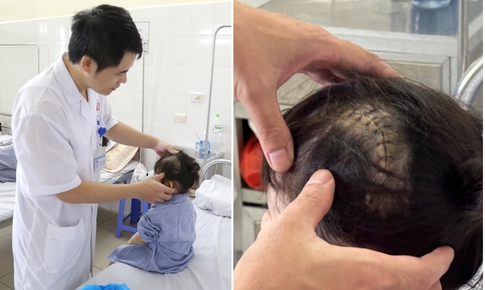 Ngã cầu thang trong lúc chơi, bé 3 tuổi bị vỡ xương sọ, tụ máu ngoài màng cứng