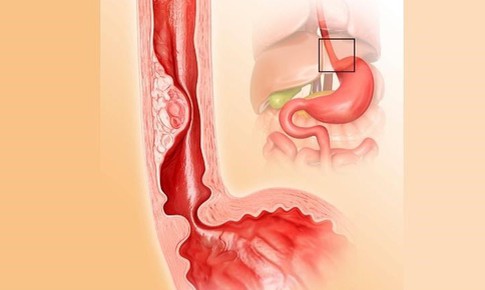 Ợ nóng, đau ngực cảnh báo viêm thực quản