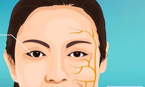 Ph&#242;ng ngừa liệt d&#226;y thần kinh số&#160;VII