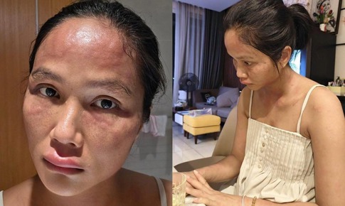 Động th&#225;i g&#226;y ch&#250; &#253; của H&#39;Hen Ni&#234; sau chia sẻ về bệnh nổi mề đay sau sinh