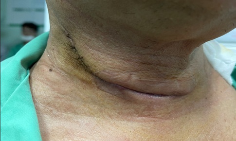 Phát hiện mắc cùng lúc 2 loại ung thư sau 6 tháng khàn tiếng