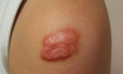 Các yếu tố nguy cơ gây sẹo lồi