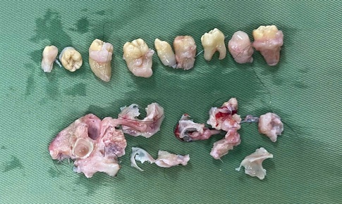 Hy hữu: B&#225;c sĩ phẫu thuật &#39;nhổ&#39; 10 c&#225;i răng trong bụng bệnh nh&#226;n c&#243; khối u qu&#225;i buồng trứng