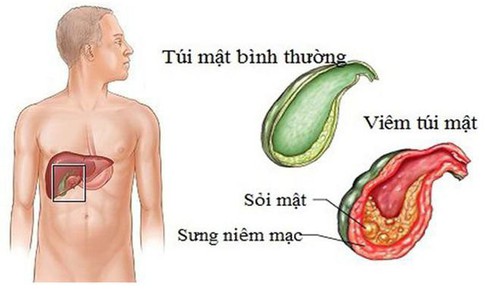 Dấu&#160;hiệu&#160;của&#160;vi&#234;m&#160;t&#250;i&#160;mật&#160;theo&#160;từng&#160;giai&#160;đoạn
