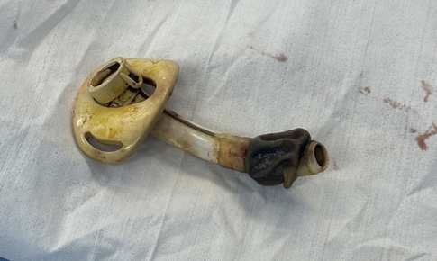 Người phụ nữ tìm lại hơi thở tự nhiên sau 7 năm sống cùng ống nội khí quản