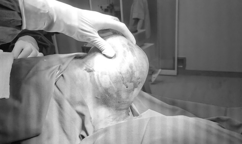 Khối u khổng lồ 1,5kg &quot;mọc&quot; tr&#234;n vai người đ&#224;n &#244;ng 41 tuổi