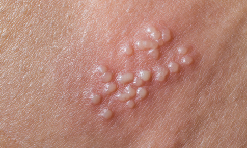 Nguy&#234;n&#160;nh&#226;n&#160;g&#226;y&#160;bệnh&#160;mụn&#160;rộp&#160;sinh&#160;dục