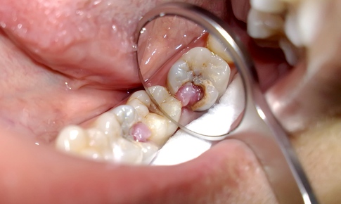 Biến chứng nguy hiểm của vi&#234;m tuỷ răng