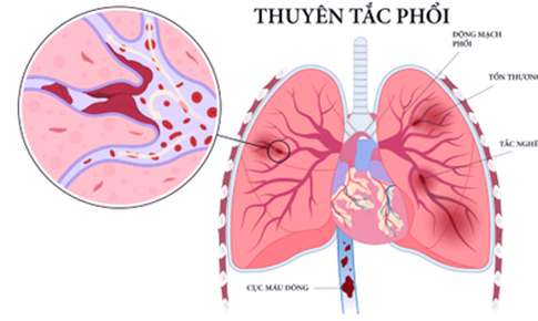Thuyên tắc phổi ở người hút thuốc lá và những người có nguy cơ mắc căn bệnh nguy hiểm này