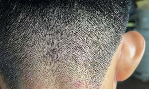 Hiểu đ&#250;ng về g&#224;u v&#224; nấm da đầu – V&#236; sao c&#224;ng d&#249;ng &#39;mẹo&#39; d&#226;n gian c&#224;ng nặng?