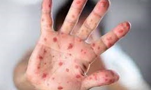Cảnh gi&#225;c với nguy cơ bệnh sởi &#39;trở lại to&#224;n cầu&#39;