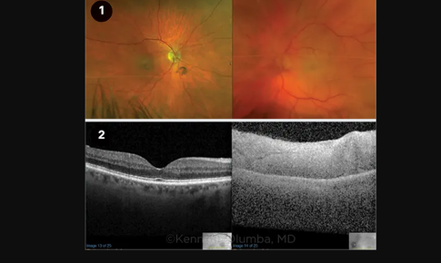 Mất thị lực sau một đ&#234;m: Cảnh b&#225;o khẩn cấp về tắc động mạch mắt