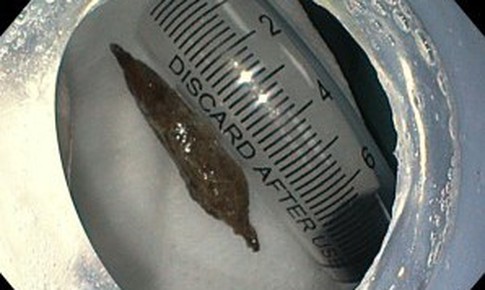 Ăn ch&#225;o yến, người phụ nữ bất ngờ bị hạt t&#225;o đỏ đ&#226;m thủng th&#224;nh dạ d&#224;y