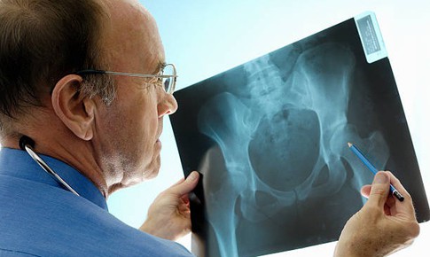 4 loại thực phẩm &#226;m thầm l&#224;m tăng nguy cơ lo&#227;ng xương