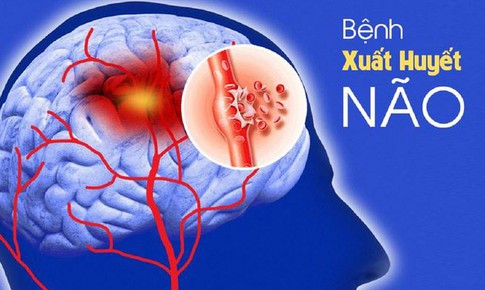 Nguy&#234;n nh&#226;n g&#226;y xuất huyết n&#227;o