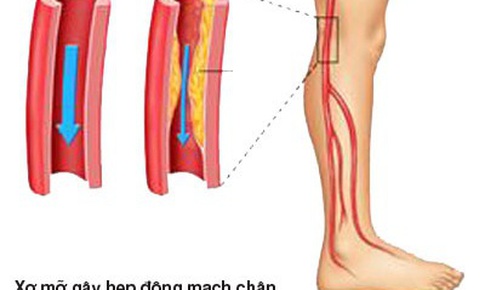 Bệnh động mạch chi dưới ở người cao tuổi dễ nặng l&#234;n v&#224;o m&#249;a lạnh