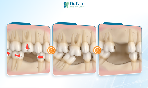 C&#243; n&#234;n trồng răng số 6 (răng cấm) khi mất răng, chi ph&#237; c&#243; đ&#225;ng với chất lượng?