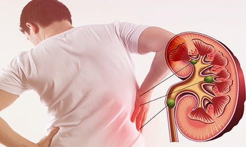 Đau lưng &#226;m ỉ một năm, người đ&#224;n &#244;ng 54 tuổi ph&#225;t hiện thận bị ph&#225; hủy bởi sỏi san h&#244; khổng lồ