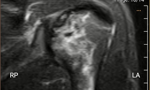 Thợ lặn biển hơn 20 năm bị hoại tử xương c&#225;nh tay, xương đ&#249;i