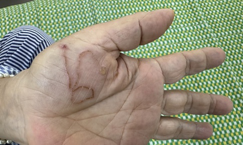 Bị nhiễm k&#253; sinh tr&#249;ng cần đi kh&#225;m v&#224; điều trị ở đ&#226;u?