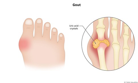 Thiếu vitamin D c&#243; thể g&#226;y tăng axit uric