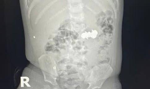 B&#233; trai nuốt 4 vi&#234;n đinh nam ch&#226;m đầu nhọn nguy hiểm
