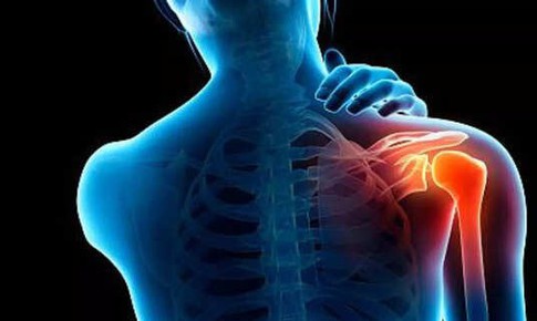 B&#224;i tập n&#224;o giảm đau vai nhanh?