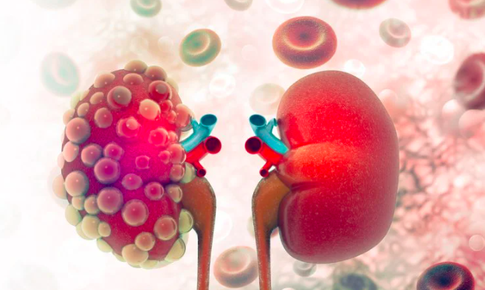 Đau lưng k&#233;o d&#224;i, người đ&#224;n &#244;ng 60 tuổi ph&#225;t hiện ung thư thận hiếm gặp