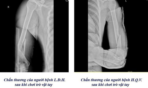 Cảnh b&#225;o nguy cơ gẫy xương c&#225;nh tay từ tr&#242; vật tay