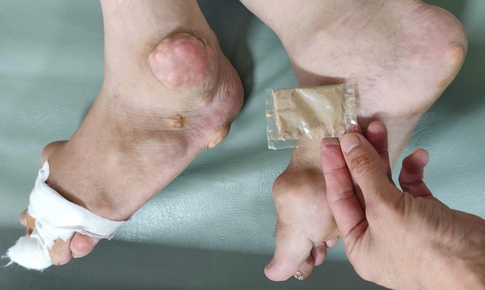 Nhiều người ‘tiền mất, tật mang’ v&#236; mua thuốc ngo&#224;i chợ, tr&#234;n mạng trị gout