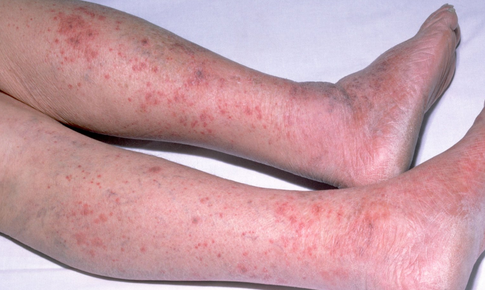 Vi&#234;m n&#227;o m&#244; cầu: Căn bệnh nguy hiểm c&#243; thể g&#226;y tử vong trong 24 giờ xuất hiện tại H&#224; Nội