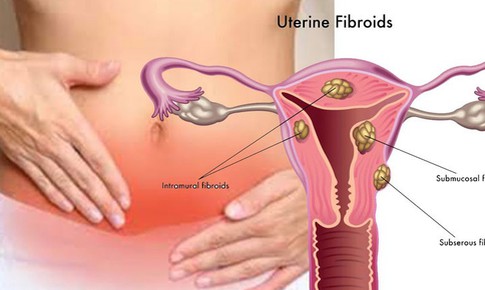 Dấu hiệu điển h&#236;nh của u xơ tử cung