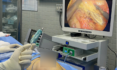 Ca phẫu thuật &#237;t x&#226;m lấn t&#225;i tạo v&#250; đầu ti&#234;n ở người gh&#233;p thận tại Việt Nam