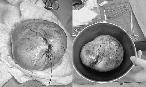 Phenikaa phẫu thuật thành công cho bé gái 9 tuổi mắc u quái buồng trứng 20 cm, bảo toàn khả năng sinh sản