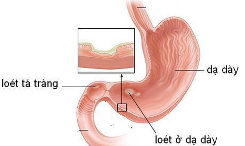 5 biến chứng thường gặp của ung thư dạ d&#224;y cần biết