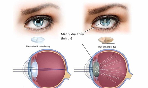 Dấu hiệu điển h&#236;nh nhận biết đục thủy tinh thể