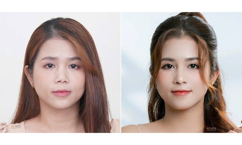 Vì sao nhiều người cần tái tạo mũi hỏng chỉ sau 1-2 năm?