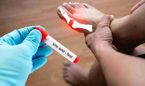 5 loại đồ uống khi đ&#243;i gi&#250;p hạ axit uric cao