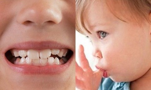 Điều trị sớm khớp cắn ngược răng sữa ở trẻ