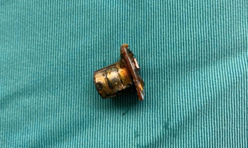 Cụm pin cúc áo trong thực quản bé trai 2 tuổi