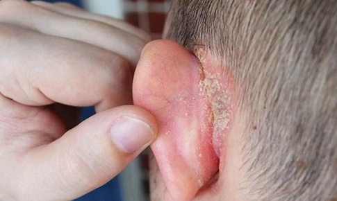 Vành tai đỏ, ngứa, khô da và bong tróc cảnh giác với bệnh chàm tai