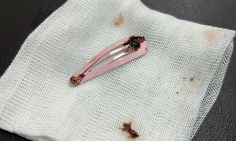 Bé 6 tuổi nhập viện cấp cứu vì nuốt kẹp tóc kim loại