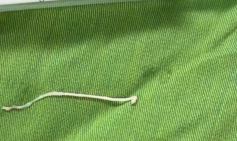 Phẫu thuật khối u, phát hiện ký sinh trùng dạng sán trong vùng hố chậu bệnh nhân